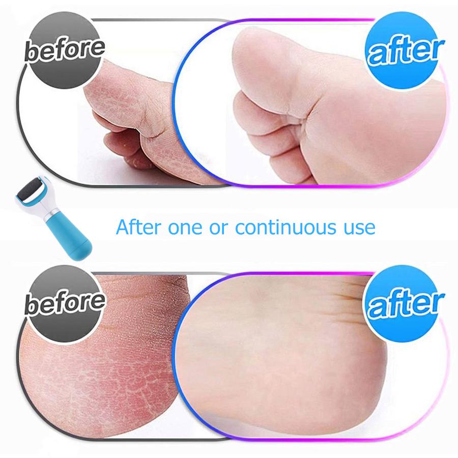 Electric Callus Remover, Foot Scrubber, Removes Corns on Feet and Hard Skin